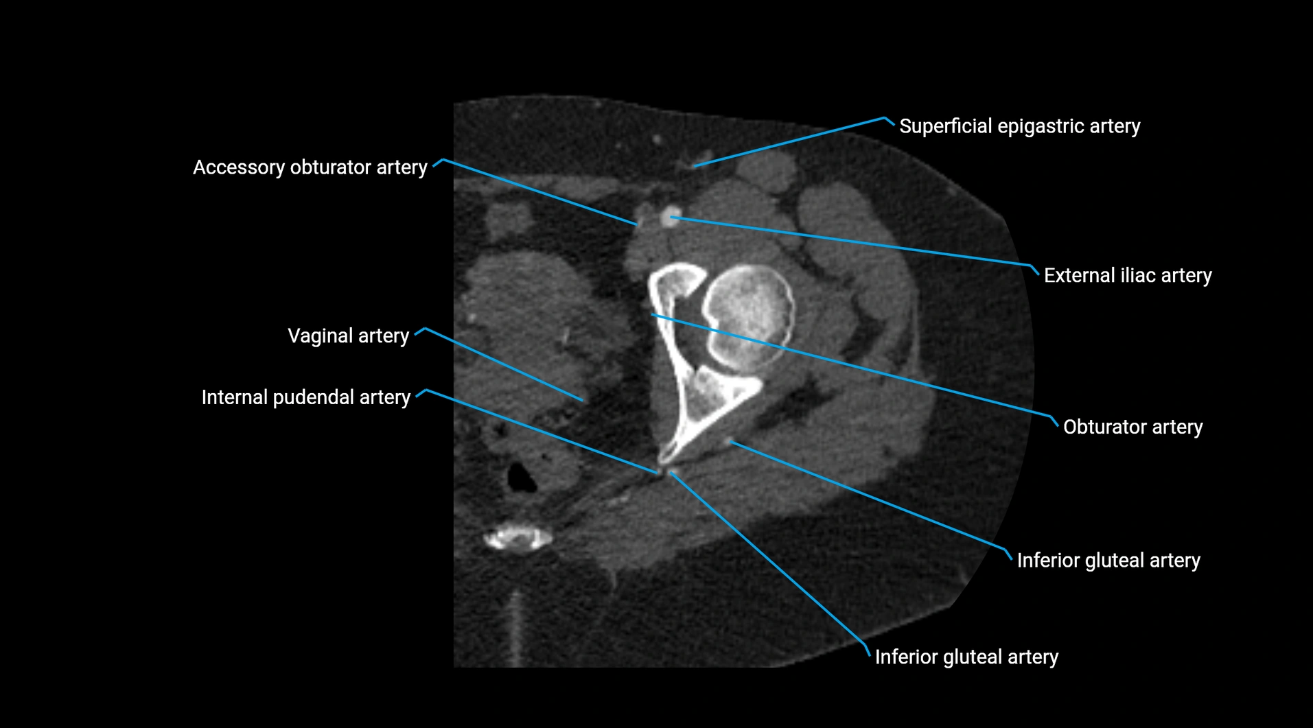 CTA lower limb cross sectional anatomy labelled image _53.webp